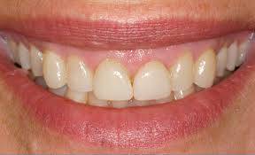 Why crown lengthening?