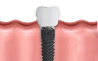 Dental Implants are great