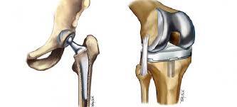 Replacement of knees & hips influences treatment