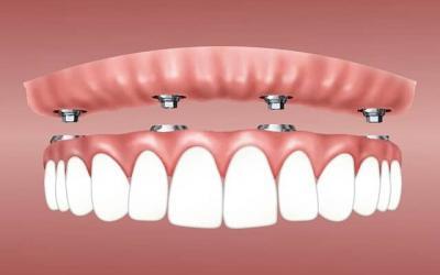 When’s a denture not a denture?…When its an overdenture!