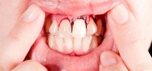 Treatment of Damaged Teeth