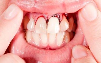 Treatment of damaged teeth after a facial trauma there are several options