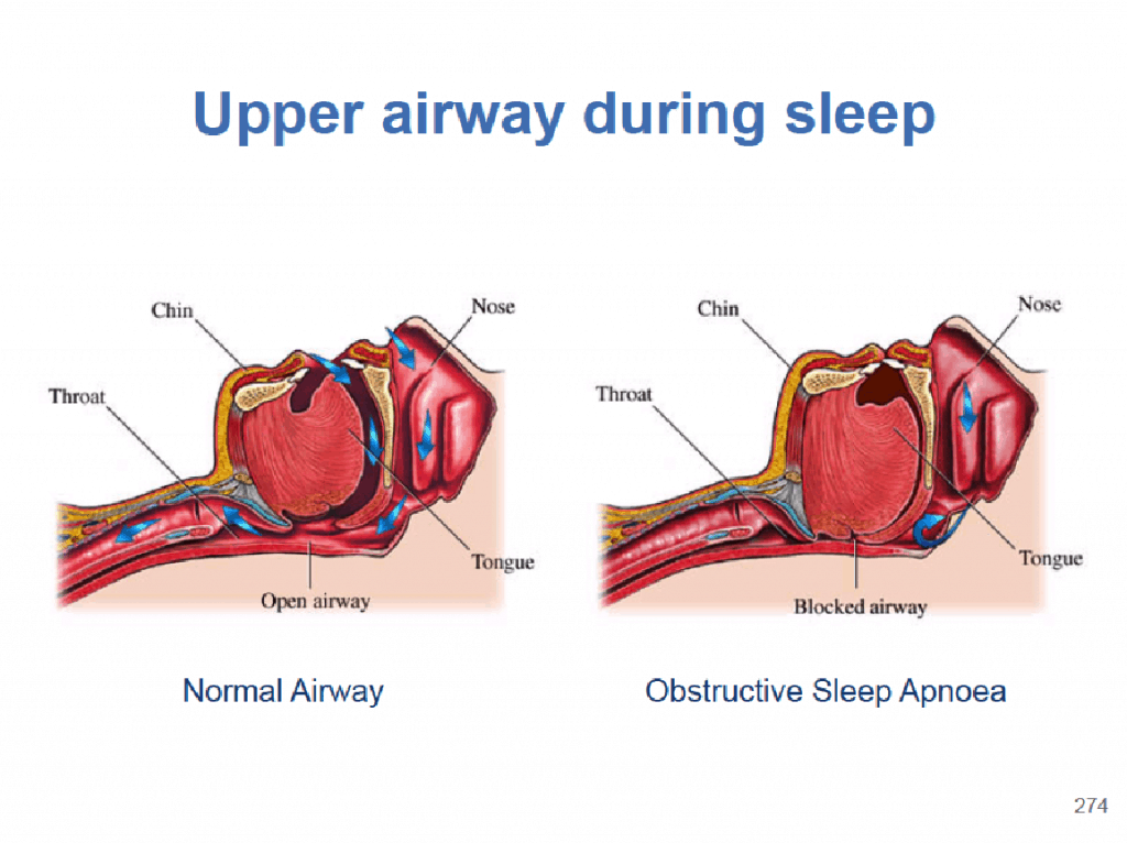 Obstructive Sleep Apnoea (OSA)