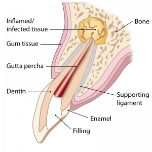 Apicectomy surgery