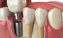 Bone Grafting May Be Required