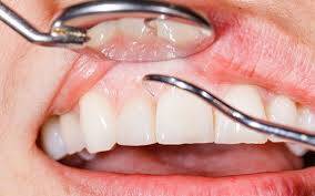 Periodontal Gum Disease