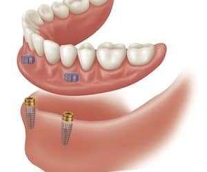 Single Stage Implant Therapy – Ph-03