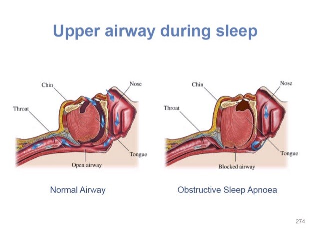 Obstructive Sleep Apnoea (snoring) | NQ Surgical Dentistry