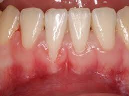 Gum recession and options for treatment – PH-26