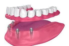 Overdentures may be the best answer for lower complete dentures – PH-23