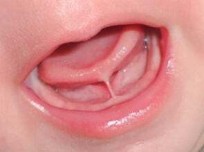 Tongue and lip tie – PH-49