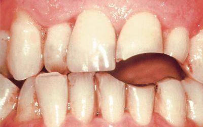 Tooth Wear – PH-33