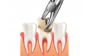 Information concerning tooth extraction & oral surgery – PH-38