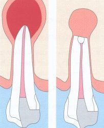 Root canal treatment and apicectomy – PH-45