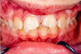 Treatment of damaged teeth – PH-29