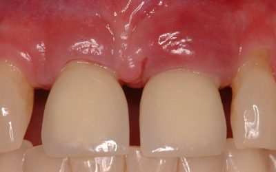 2017 CLASSIFICATION OF PERIODONTAL AND PERI-IMPLANT DISEASES AND CONDITIONS – PH-64